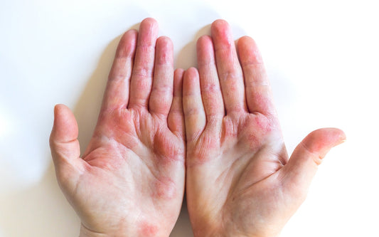 Chaga Mushroom's Impact on Allergic Inflammation